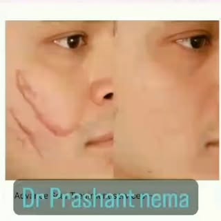 #advance scar treatment # Scar revision # post trauma scar treatment#acne scar treatment #facial sca