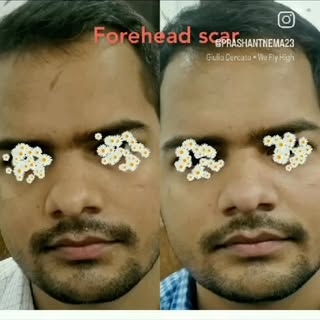 #advance scar treatment # Scar revision # post trauma scar treatment#acne scar treatment #facial sca