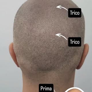 ⚫️ Nella Trico ad effetto rasato usiamo tecniche per creare una riproduzione follicolare vera e prop
