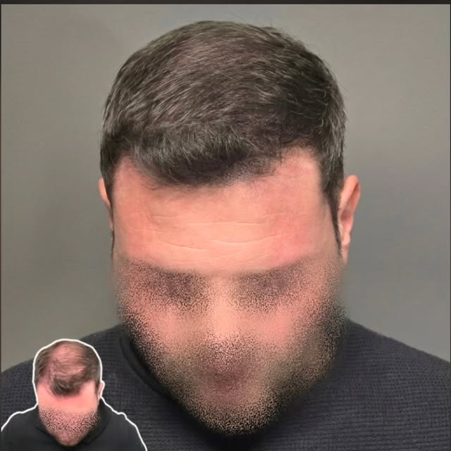 ⚫️ Tricopigmentazione effetto densità

Guarda che bel risultato. Guarda che cambiamento.
Un effetto 