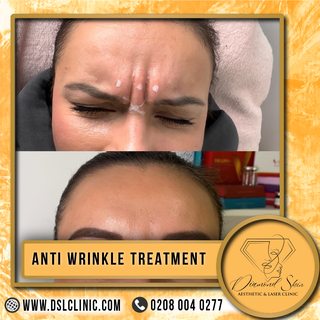 Wrinkles got you down?  We've got you covered! ✨ Diamond Skin Aesthetic offers personalized Anti-Wri