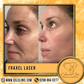 Ready to reveal your most radiant skin? ✨ Fraxel laser treatment at Diamond Skin Aesthetic, Wembley'