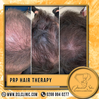 Thinning hair got you down?  PRP Hair Therapy is the answer! ✨ Diamond Skin Aesthetic uses your own 