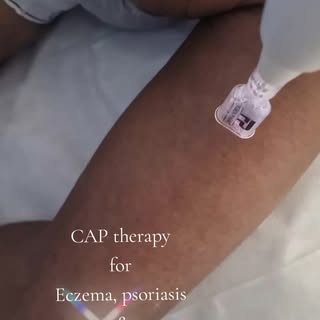 #tswclub #skincarespecilist #captherapy #eczemawoes #tswsucks #psoriasistreatments #eczemarelieftrea