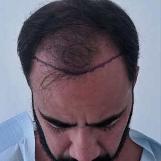 Apenas a 6 meses de su trasplante 
Notas alguna diferencia? 

Trasplante capilar realizado en Hondur