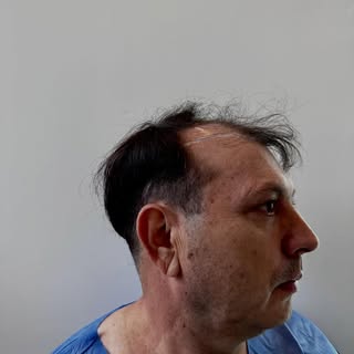 Este antes y después corresponde a un procedimiento de trasplante capilar médico, realizado tras un 