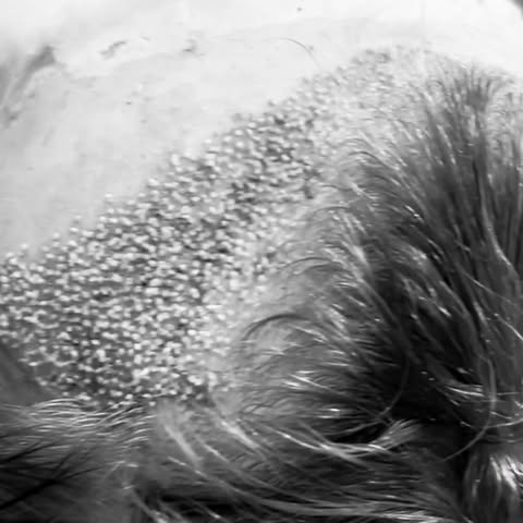 Para aquellos que desean disimular las entradas sin alterar su look actual, en Medical Hair podemos 