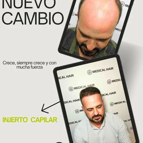 NUEVO CAMBIO 🔝

En Medical Hair Benidorm, hacemos realidad tu sueño 🧔🏻🔝

#injertocapilar #medica