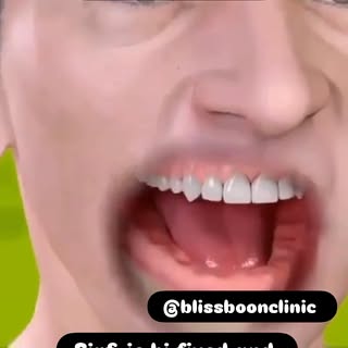 Fixed Dental Implants 
One & Only fixed permanent solution for Edentulous jaw 
#blissboonclinic