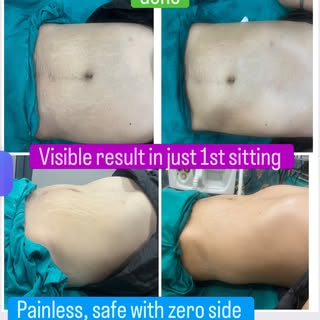 Body slimming procedure (RF) done
Painless, safe with zero side effects 

Are you also worried bcoz 