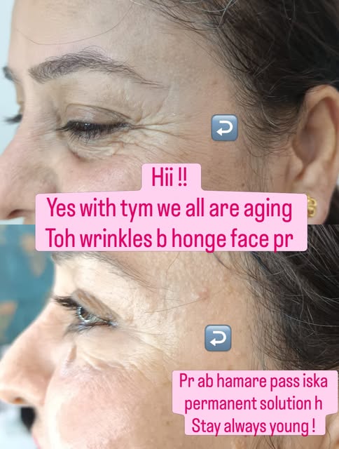 Hii ! 
With tym we all are aging 
Toh wrinkles toh honge h

But now we have permanent solution for t