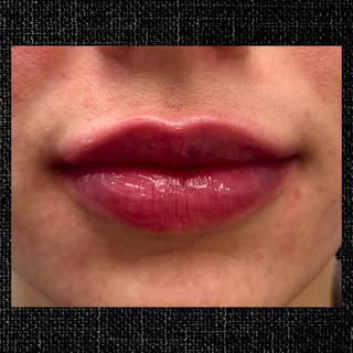When filler enhances your natural beauty and confidence✨

Injector: Stefany
📍Newtown