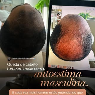 A queda de cabelo também virou uma conversa sobre autoestima masculina.

Por muito tempo, falar sobr