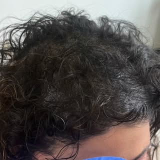 Scalp micropigmentation gives the illusion of fuller, denser hair by tinting the scalp to blend with