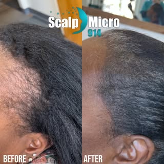 Are you feeling insecure about your thinning edges showing scalp?

Tired of trying to disguise it wi