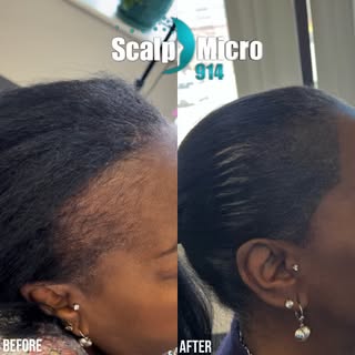 Are you feeling insecure about your thinning edges showing scalp?

Tired of trying to disguise it wi