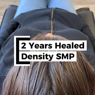 2 YEARS HEALED SCALP MICROPIGMENTATION ✨

This client originally came in for density, and this is he