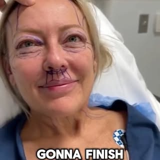 Here we have our beautiful 51 year old patient 6 months post-op who had an Extended Deep Plane Face 