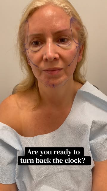 Our lovely patient is officially ONE YEAR post-op, and this is exactly why we love showing long-term