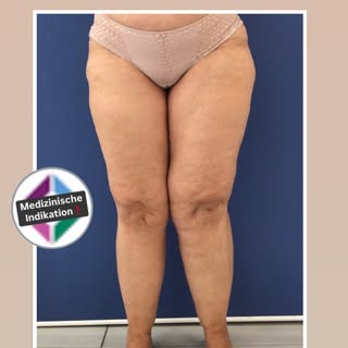 ❗️MEDIZINISCHE INDIKATION❗️
Lipödem Stadium 2. Die Patientin hatte unter Schmerzen in den Beinen und