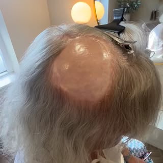 This lovely lady had a basal cell carcinoma removed, leaving behind a very large scar on her scalp, 