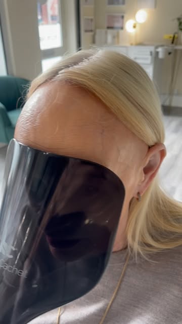 FFA TRANSFORMATION

Frontal Fibrosing Alopecia (FFA) can cause significant hair loss around the hair