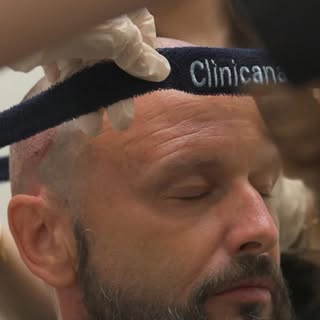 Nobody tells you about week 3. 😳
Here’s what ACTUALLY happens after a hair transplant — month by mo