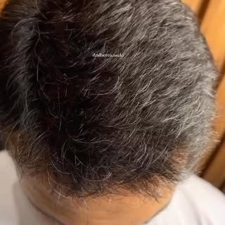 Resultado simplesmente incrível. 
Veja por quê:
- é impossível dizer que há um transplante
-os fios 