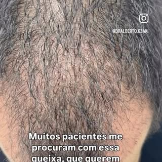 Muitos pacientes me procuram para aumentar sua densidade através do transplante. 

O objetivo é perm