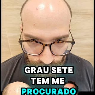 É muito cabelo!!

Eu quero a perfeição então daqui a 30 dias vou implantar mais cabelo nele até fech