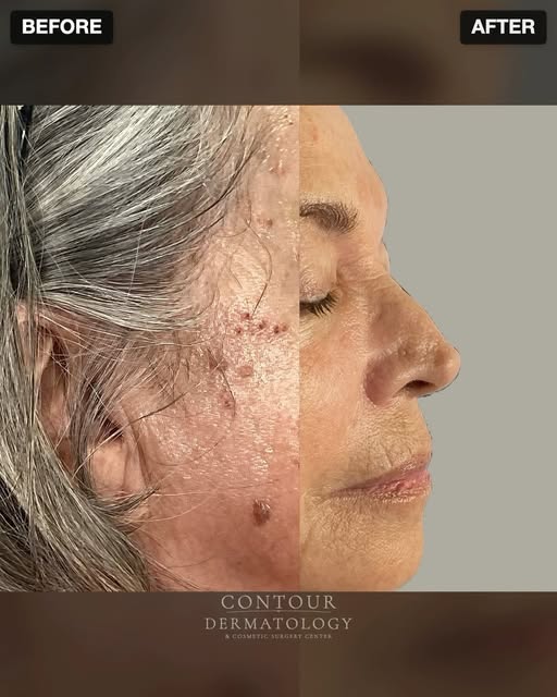 A little light can make a visible difference ✨
 
Take a look at these IPL Laser before and after res