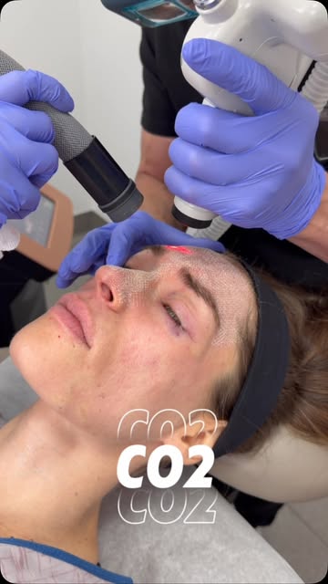 Why do we love CO₂ laser? 👀
 
Because our NEW and POWERFUL UltraPulse Alpha CO₂ Laser takes skin re