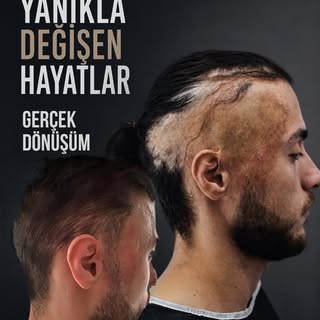 Bazı izler geçmişi anlatır.
Bazı değişimler ise geleceği yeniden şekillendirir.

Yanık sonrası saç k