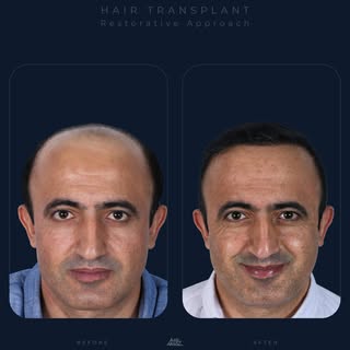 Doğallık, değişimin fark edilmemesidir.

Saç ekiminde hedef yalnızca boş alanları doldurmak değil; y