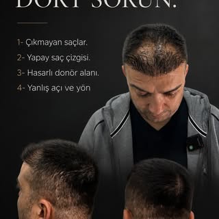 Bir saç ekiminde sorun yalnızca saçların çıkmaması değildir.

Yapay bir saç çizgisi, yanlış açı ve y
