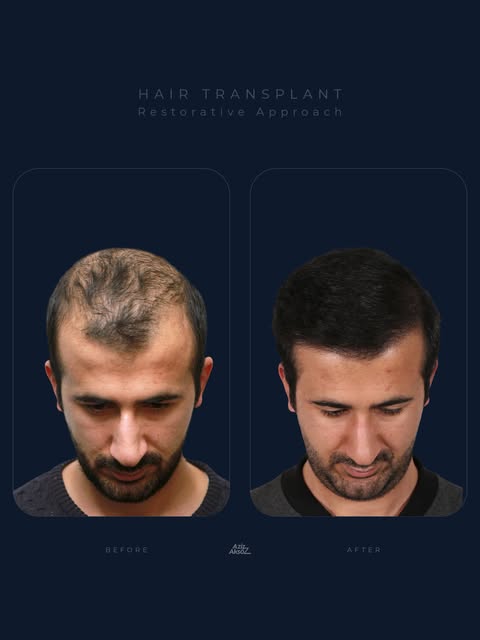Saç dökülmesi devam eden bir süreçtir. Bu nedenle planlama yalnızca mevcut açıklığa göre yapılmaz; v
