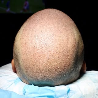 Hair Transplant Success with 6,000 Grafts at Zeeva Hair and Skin Clinic!

Witness the transformation