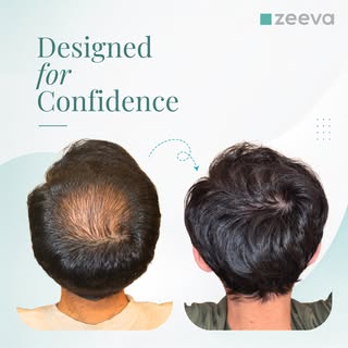 Hair loss doesn't just change your appearance—it can affect how you feel every day.

At Zeeva Clinic