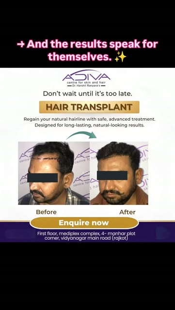 Adiva skin and hair centre - 8320071916
.
.
.
A new hairline. A fresh look. A boost in confidence. ✨