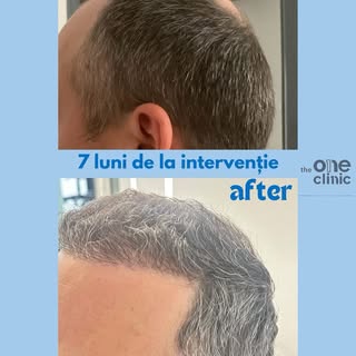 ✨ Rezultate incredibile după doar 7 luni!✨

La The One Clinic, îți redăm încrederea prin transformăr