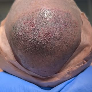💆🏻‍♂️Transplante capilar feito e o resultado? Sucesso absoluto! Mas chegar até aqui foi fruto de u