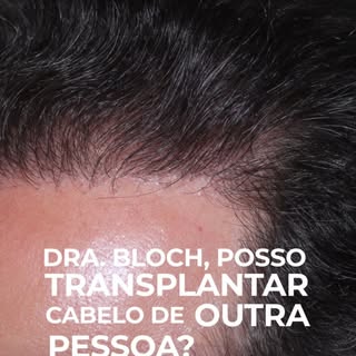 Você sabia que é possível realizar um Transplante Capilar Alogênico (entre pessoas diferentes)?

 No