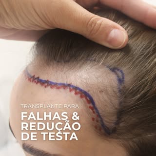 Você sempre ouviu que “tem a testa grande” ou notou entradas que te incomodam no espelho?
⠀
Você não