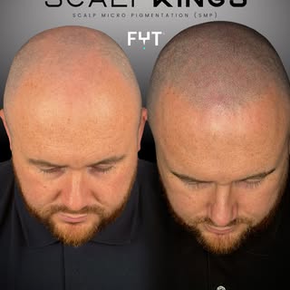 Transformational = Sensational 🔥

 
A fuller look starts here 🔥

SMP = the ultimate #HairTattoo fo