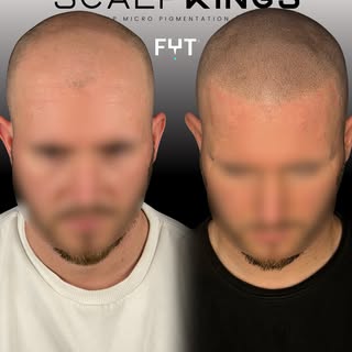Scalp Micro Pigmentation Transformation 😎

Cartridge: @fytsmpofficial x @fytsmp 
Artist: Pro FYT Ar