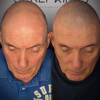 Transformation assembled 📸

🔥 A FULLER LOOK STARTS HERE.

Hair thinning? Receding hairline? Bald s