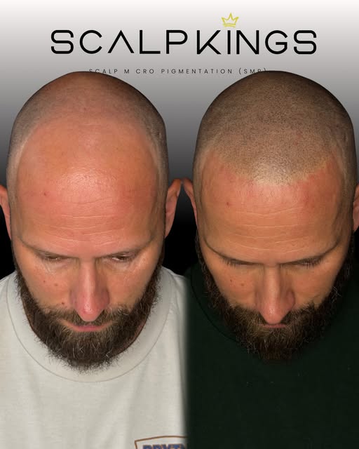 Subtle ✅ Natural ✅ Complete ✅ 

Hair thinning? Receding hairline? Bald spots? Or simply not happy wi