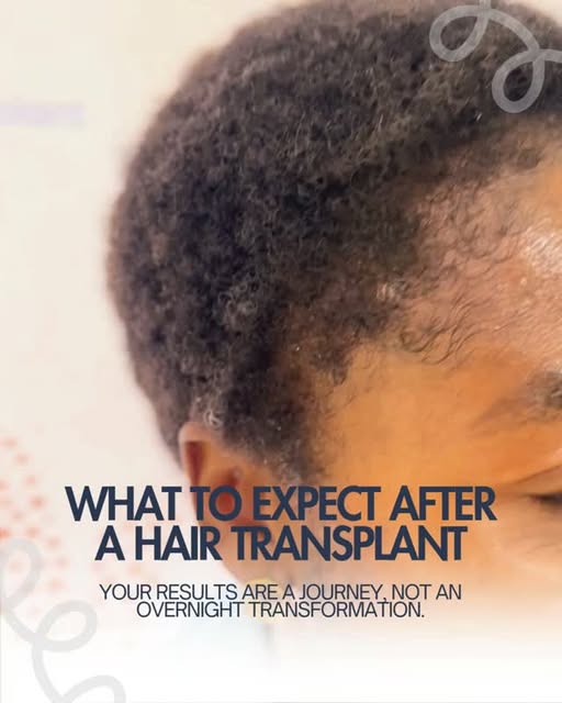 Hair restoration is a journey, not an overnight result. 🌱⁠
⁠
From the first stages of recovery to t