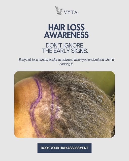Hair loss often starts with small changes, more shedding than usual, a widening part, thinning aroun
