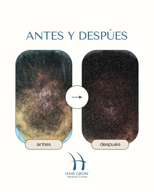 Los cabellos afro también se recuperan de la calvicie mediante el tratamiento de regeneración capila